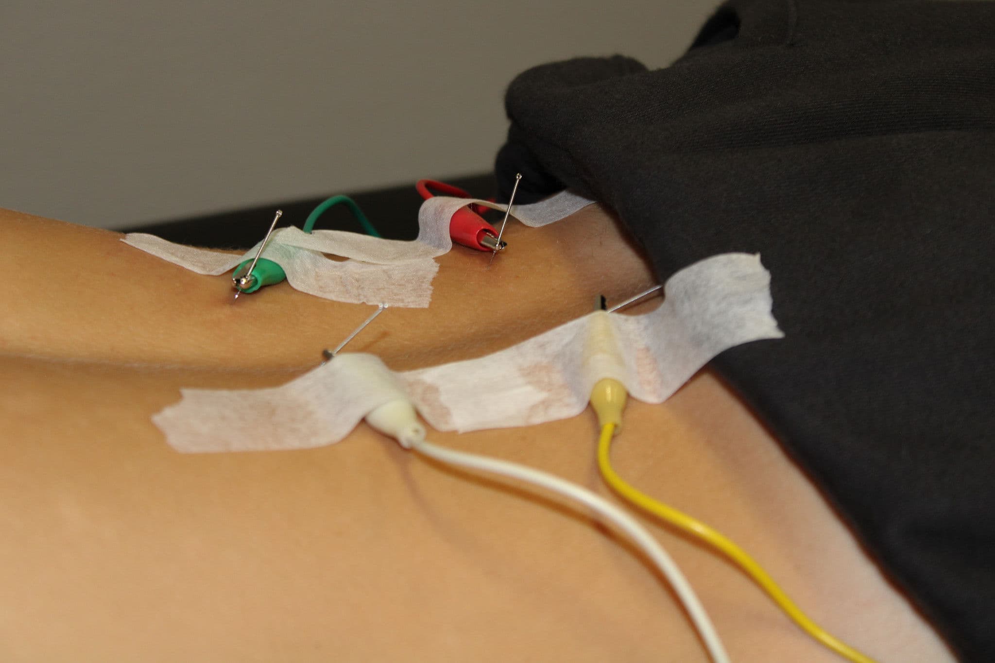TENS Unit Therapy